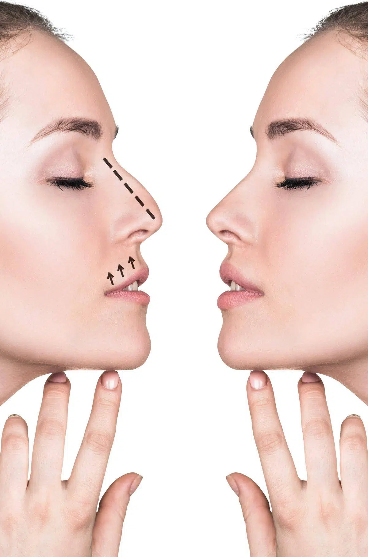 Nasenkorrekturen werden bei Nasenhöcker, bei einer Schiefstellung der Nase oder zur Korrektur der Nasenspitze durchgeführt.