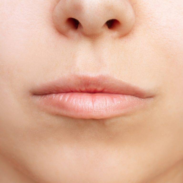 Lippenunterspritzung vorher