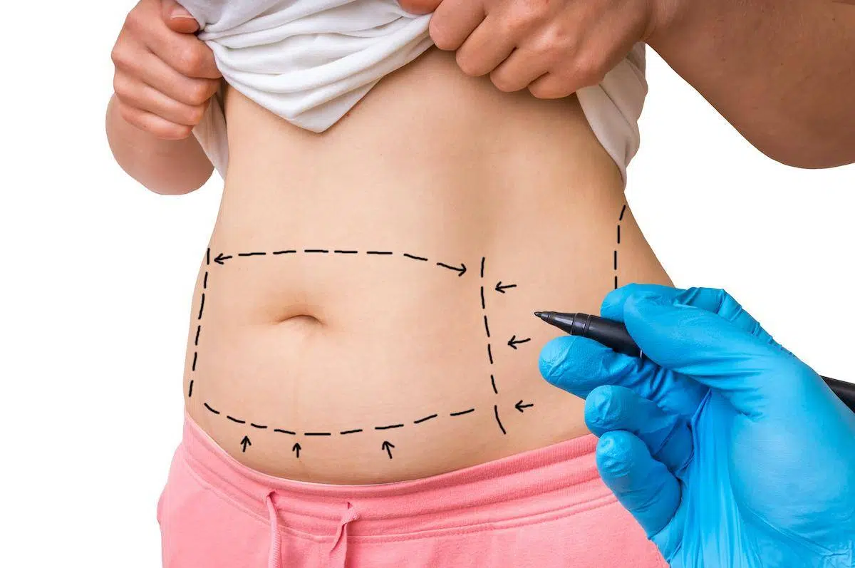 Fettabsaugung Körper, abgesaugtes Fett wird auch verwendet für Brustvergrößerung, zur Penisverdickung und zur Narbenbehandlung .